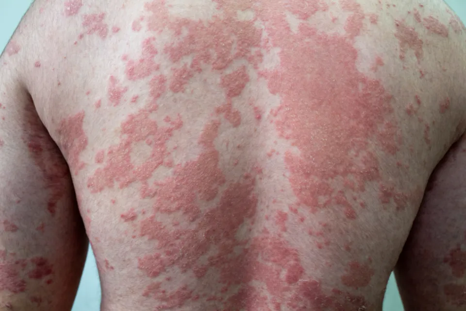 Psoriasis | Donnelley Dermatology | Manhattan, NY